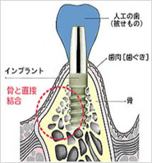 AQBインプラント