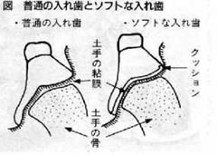 入れ歯の比較