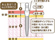 ミニインプラント義歯2